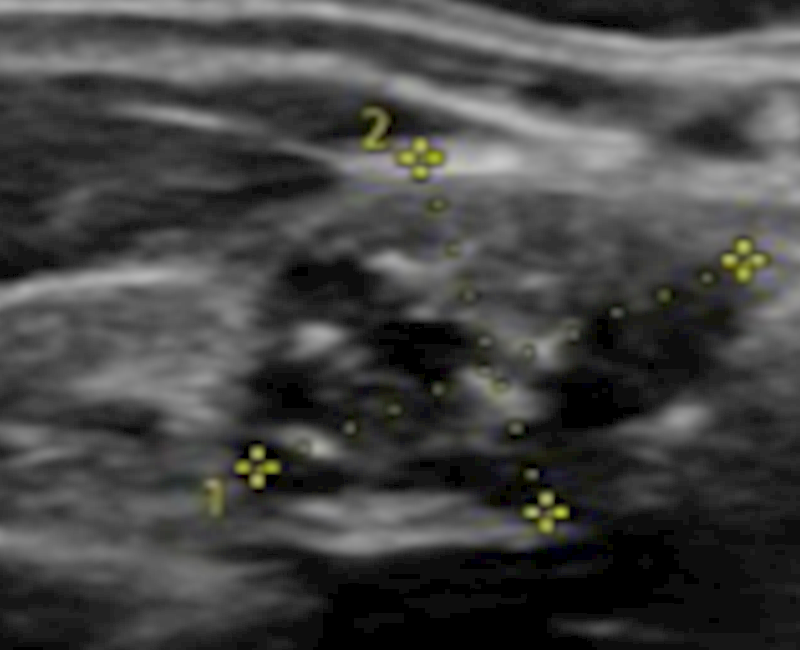 Thyroglossal duct cyst papillary carcinoma with lymphatic infiltration: A case report